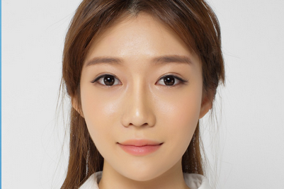 韩国崔德浩-双眼皮手术日记对比图