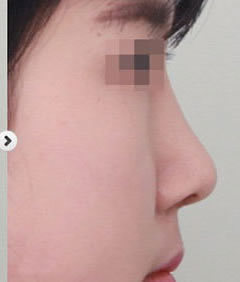 韩国vine医院隆鼻手术日记对比图