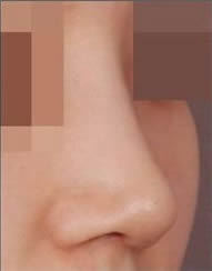 韩国伍人整形外科-隆鼻手术案例对比图