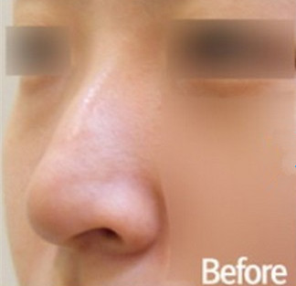 韩国狎鸥亭艾薇-隆鼻手术对比图