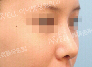 韩国iWell-韩国iwell医院驼峰鼻矫正对比案例