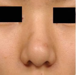 韩国美整形外科隆鼻修复手术案例对比图_术前