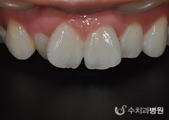 韩国SU牙科医院牙齿贴面矫正前后对比案例图_术前