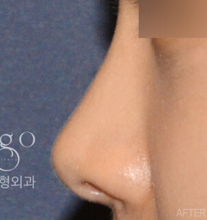 MIGO整形外科-隆鼻手术对比日记