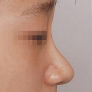 韩国ILOVE-隆鼻手术日记对比图