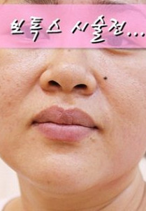 韩国DK整形外科瘦脸手术对比日记