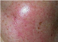 韩国美典皮肤科-祛痘疤对比图