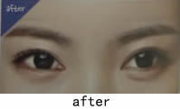 韩国TL整形医院-卧蝉眼手术前后对比