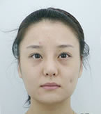 韩国smallface整形外科颧骨缩小+下颌角手术对比案例_术前