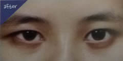 韩国TL整形医院-男性眼部整形案例