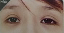 韩国TL整形医院-眼部修复术案例