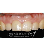 韩国优露牙科-牙齿矫正手术对比日记