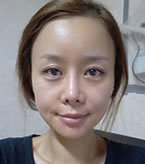 韩国丽妃-毛发移植+颧骨缩小手术对比日记