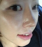 韩国现代美学整形医院-韩国现代美学隆鼻失败修复手术对比案例