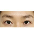 韩国春天UVOM整形外科埋线双眼皮矫正对比案例