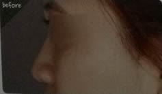 韩国TL整形医院-鼻梁整形矫正对比