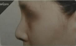 针对型鼻尖整形案例