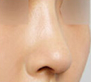 韩国鼻整形研究所-韩国隆鼻整形对比日记