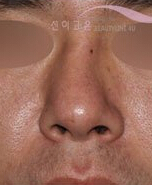 韩国Beautyline4u整形-​韩国歪鼻矫正整形对比日记