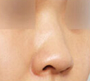 韩国鼻整形研究所-韩国隆鼻整形对比日记