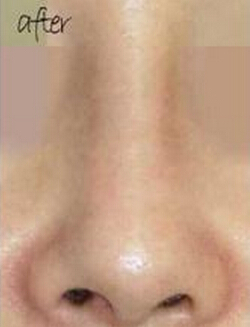 韩国丽丝整形外科医院-歪鼻矫正术对比日记