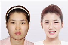 韩国博朗温整形外科医院做脸型效果好不好？