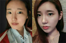 【真实案例】韩国做面部轮廓手术到底靠不靠谱？