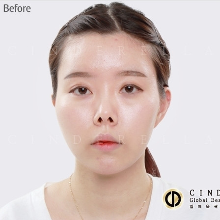 韩国灰姑娘整形医院鼻部修复对比图