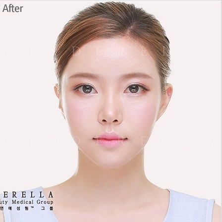 韩国灰姑娘整形医院鼻部修复对比图_术后