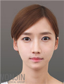 韩国原辰整形外科-韩国原辰双鄂+面部轮廓对比案例效果