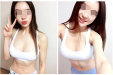 韩国女神整形外科医院假体隆胸效果怎么样？