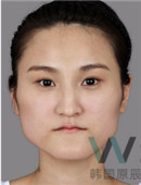 韩国原辰整形外科-韩国原辰下颌角+颧骨内推案例对比