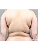 韩国365mc医院背部吸脂对比案例