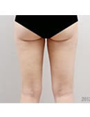 韩国365mc医院大腿吸脂对比案例
