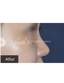 韩国4月31日整形外科隆鼻手术案例对比图_术后
