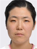 韩国灰姑娘整形医院上睑下垂矫正手术对比案例_术前