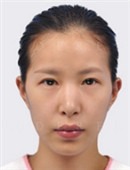 韩国新帝瑞娜整形外科眼部修复手术对比图_术前