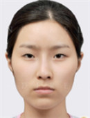 韩国灰姑娘眼部整形对比案例