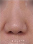 韩国心美眼整形-隆鼻手术案例对比图