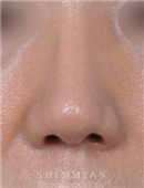 韩国心美眼整形-隆鼻手术案例对比图
