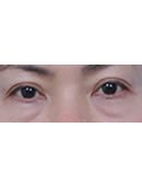 韩国心美眼整形-去眼袋手术对比图