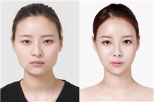 韩国整形长曲线下颌角的效果好吗？