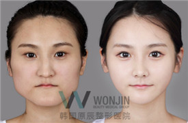 韩国原辰医院下颌角整形效果怎么样？