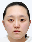 韩国FACE-LINE整形外科-双鄂手术、V-line下巴缩小术等六项手术让她改变效果非常大