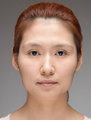 在韩国爱我整形医院做了颧骨和隆鼻，变成混血脸_术前