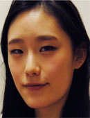在韩国id整形做双颚+双眼皮手术怎么样？效果好吗？_术前