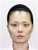 韩国博朗温整形外科-韩国博朗温全脸整形六个月全记录