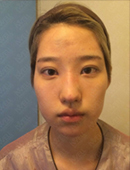 在韩国iwell医院做完脸型和隆鼻就能在韩国出道当艺人了