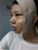 韩国OPERA整形外科-在欧佩拉做了面部轮廓和眼部修复手术，效果特别棒！
