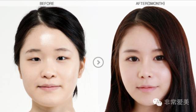 韩国原辰和丽珍哪家医院做双眼皮更出色？
